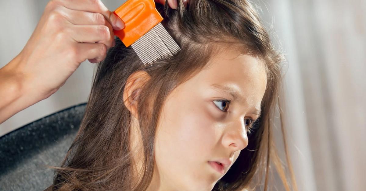 Loại bỏ chấy tóc an toàn cho trẻ với 5 mẹo từ Viên Thuốc Xanh
