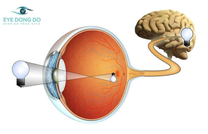 Teo dây thần kinh thị giác – đánh cắp thị lực một cách thầm lặng