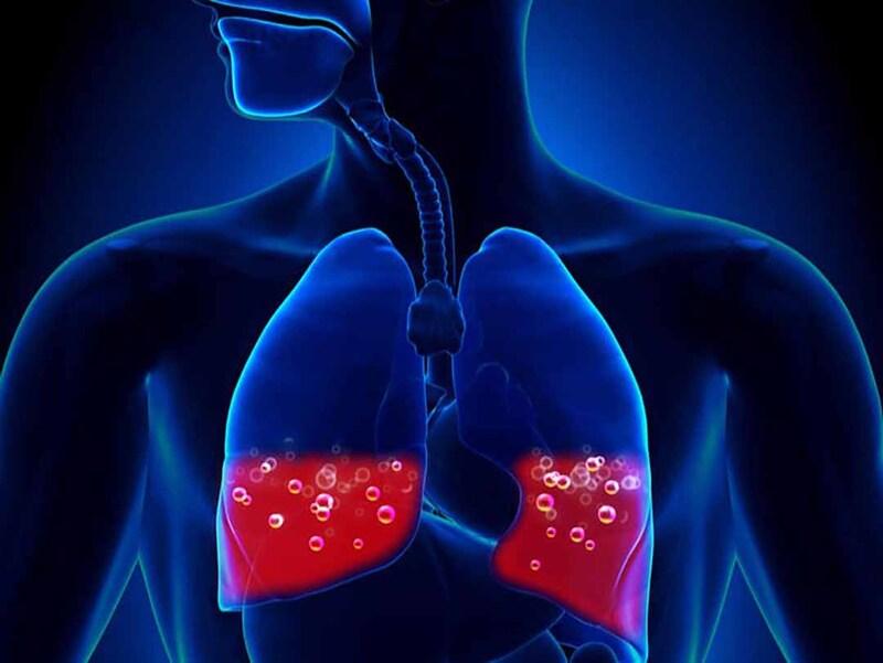 Phù phổi cấp: Nguyên nhân và cách điều trị