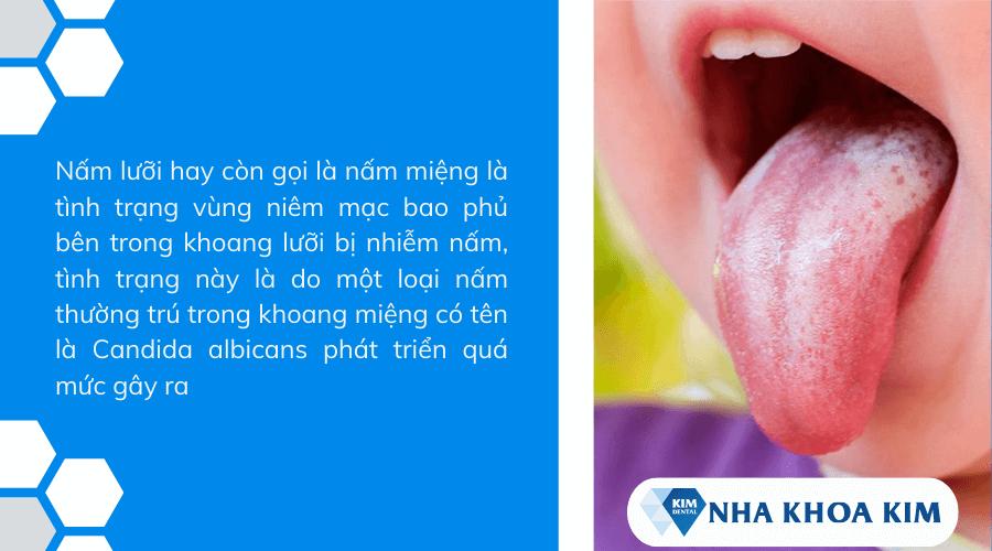 Nấm lưỡi là bệnh gì? Triệu chứng, nguyên nhân và cách điều trị
