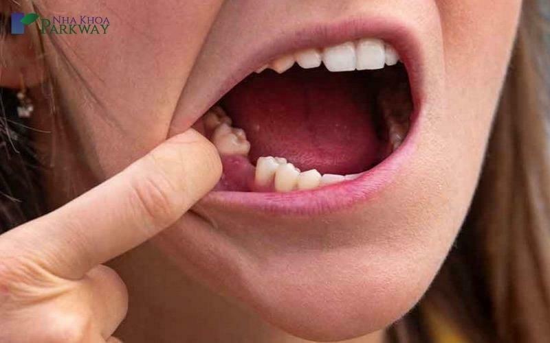 Nằm mơ thấy rụng răng hàm dưới có ý nghĩa thế nào?